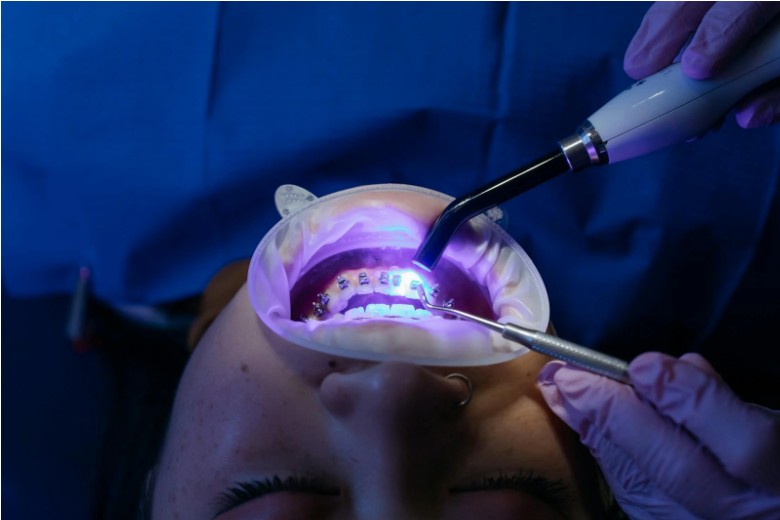 What is the Best Method of Teeth Whitening?