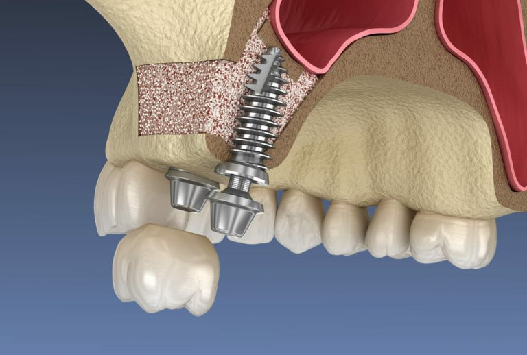 Guided Sinus Lifts: Crestal Vs Lateral Approaches Explained